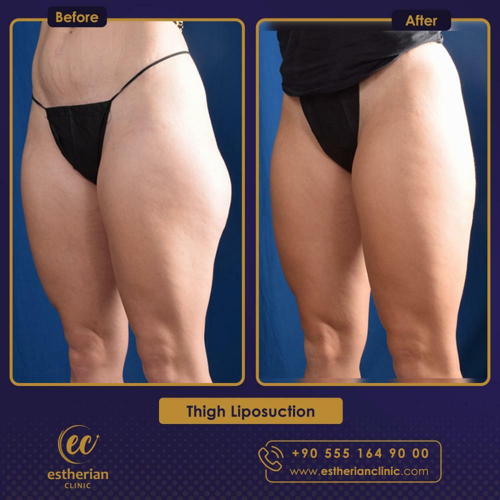 thigh lift surgery in Turkey